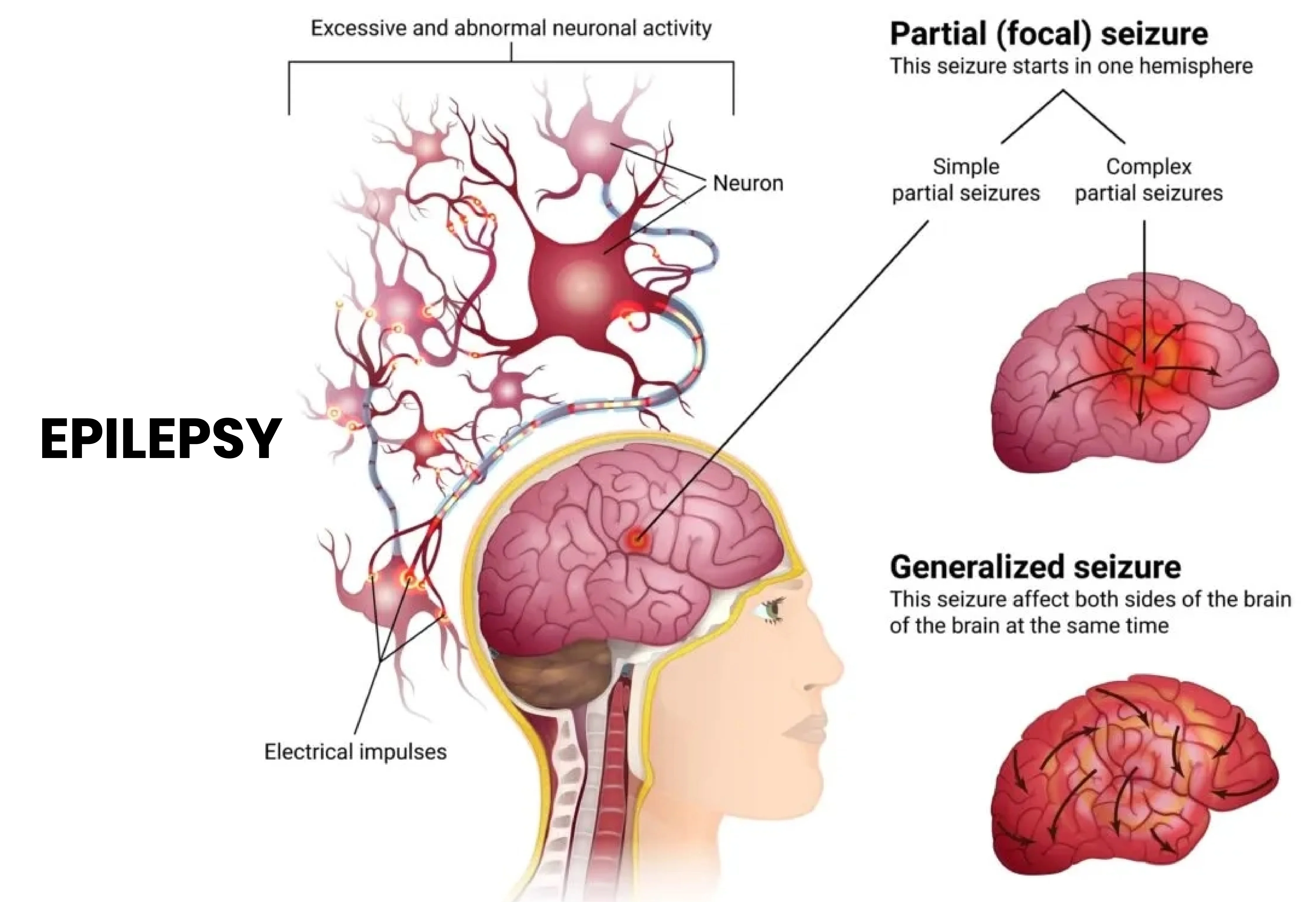 Epilepsy Treatment & Surgery Hospital